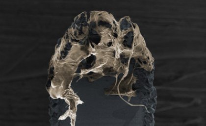 This is a pseudo-colored image of a human skin tissue (brown) obtained by a micro-sized biopsy device (blue) developed to address the need for a minimally invasive sampling of photoaged skin. Courtesy of Ms Li Lin, The University of Queensland. This is a pseudo-colored image of a human skin tissue (brown) obtained by a micro-sized biopsy device (blue) developed to address the need for a minimally invasive sampling of photoaged skin. Courtesy of Ms Li Lin, The University of Queensland.